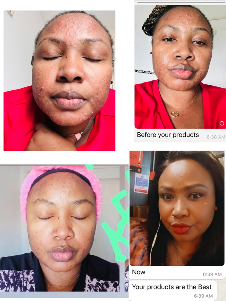 Facial Acne & Pimple Serum.